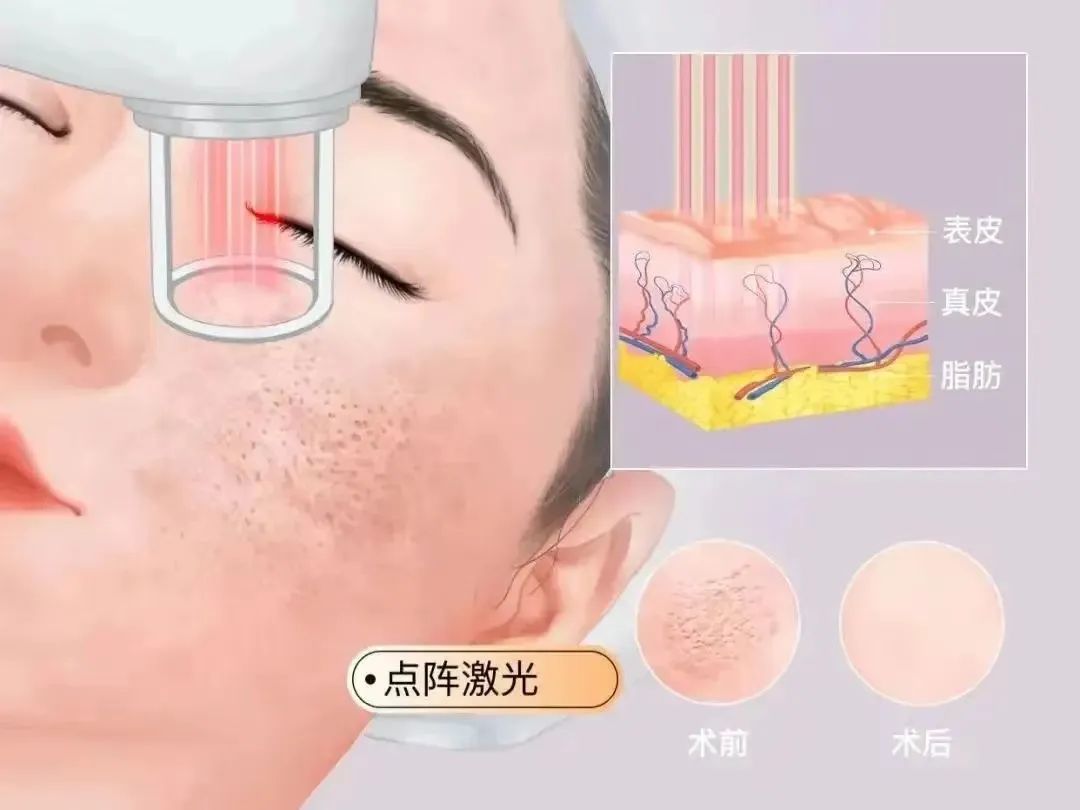 点阵激光究竟是什么